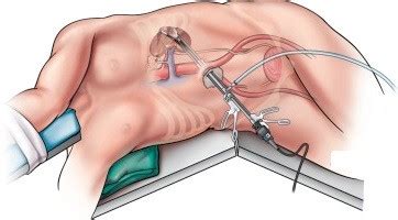 Image result for Nephrectomy Approach