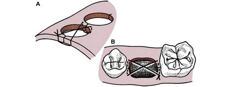 Section IIA Introduction to Suturing - Journal of Oral and ...