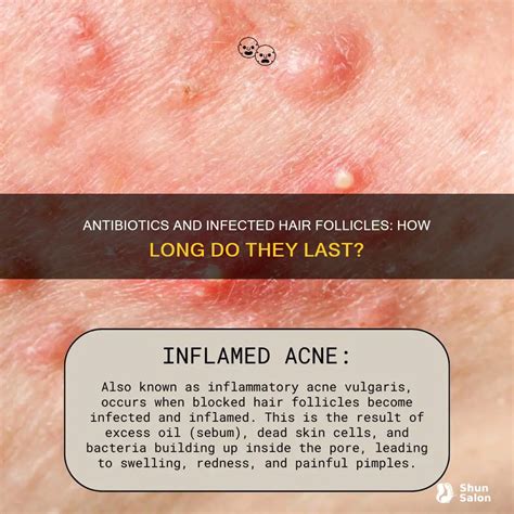 Antibiotics And Infected Hair Follicles: How Long Do They Last? | ShunSalon