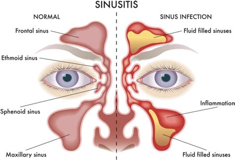 Sinusitis - Primary Care: Clinics in Office Practice