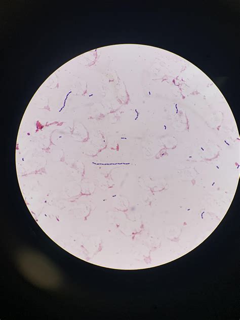 Gram stain of positive blood cx bottle. GPCCH, enterococcus faecalis ...