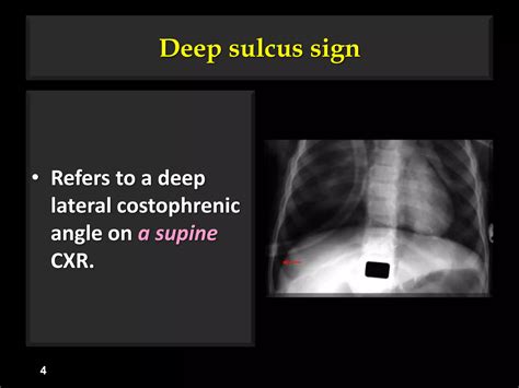 Sulcus Sign Explained 的图像结果