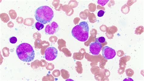 Acute Myelomonocytic Leukemia
