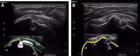 Intraosseous migration of supraspinatus calcification: benefits of intraoperative ultrasound ...