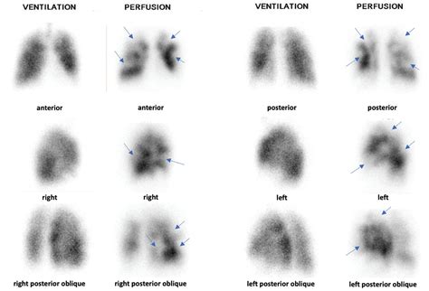 Frontiers | Quantification of the pulmonary vascular obstruction index ...