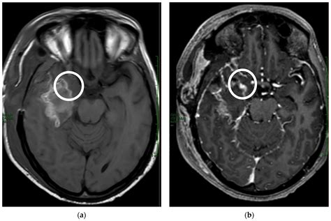 Coronal T1 Mri at Laura Mullen blog