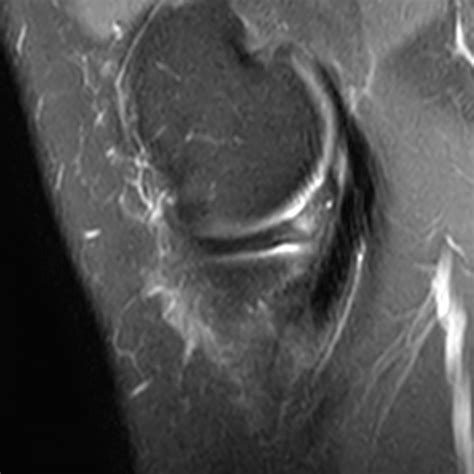 Bucket-handle Tear of the Meniscus - Radsource