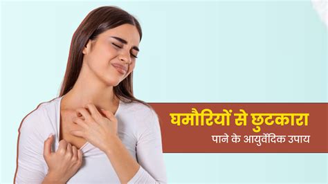 घमौरियों से छुटकारा पाने के लिए आजमाएं ये 5 आयुर्वेदिक उपाय | Ayurvedic ...
