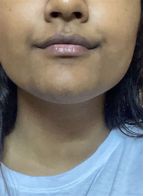 How to remove hyperpigmentation of lips and the area around? : r/Skincare_Addiction