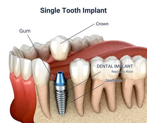 Single Tooth Implant