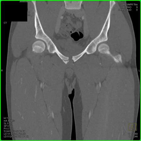 Fracture Treatment Inferior Pubic Ramus at Hayden Seekamp blog