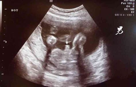 孕12周胎儿小鸡彩超图解，两腿之间有凸起就稳了 - 姐妹邦