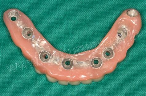 » MULTI UNIT BASAL IMPLANTS
