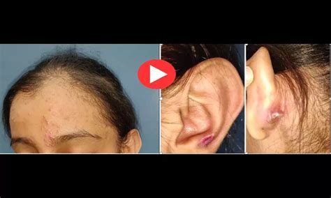 Indian study points to Turban Triad skin disease