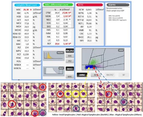 Burkitt lymphoma (Clinical Case) - HORIBA Hematology