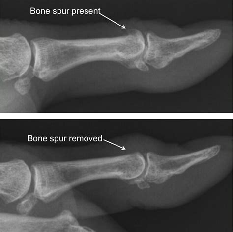 Can Bone Spurs In Mouth Be Removed at Monte Stock blog