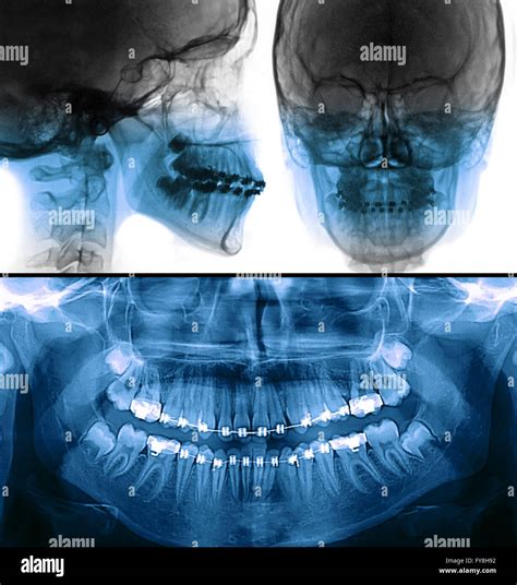 Dental panoramic x ray hi-res stock photography and images - Alamy