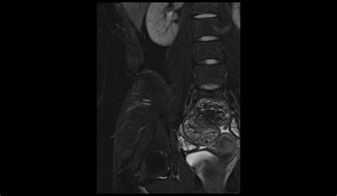 Image result for Normal Appendix MRI