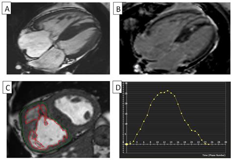 Cardiac Magnetic Resonance Imaging in the Evaluation of Functional ...