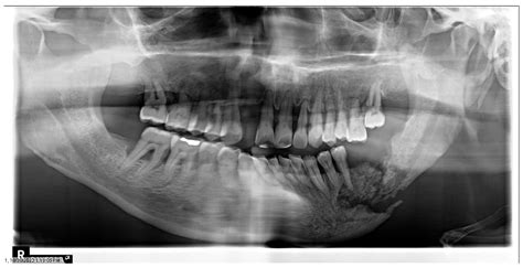 The Role of Dental Practitioners in the Management of Oncology Patients: The Head and Neck ...