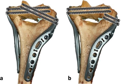 The importance of interdigitating screw fixation of the trochlea in ...
