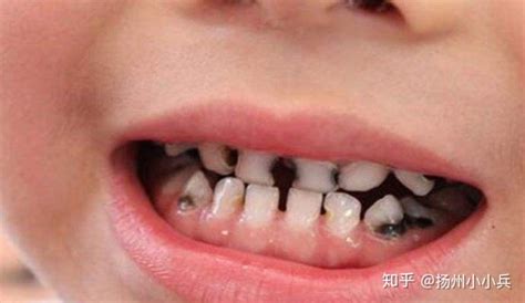 扬州口腔：你爱喝的碳酸饮料对牙齿的伤害简直可怕 - 知乎