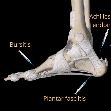 Steroid Injection Plantar Fasciitis Cost Uk at Rebecca Bowens blog