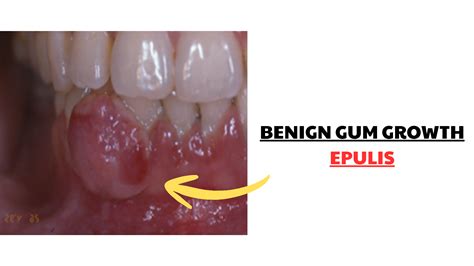 A Lump or Bump on Your Gum? Here’s What It Could Mean (Pictures)