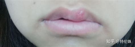 【嘴唇周围长痘痘是什么原因】【图】嘴唇周围长痘痘是什么原因？ 4个根因提醒你们(2)_伊秀健康|yxlady.com