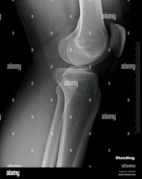 X-ray film of healthy male knees Stock Photo - Alamy