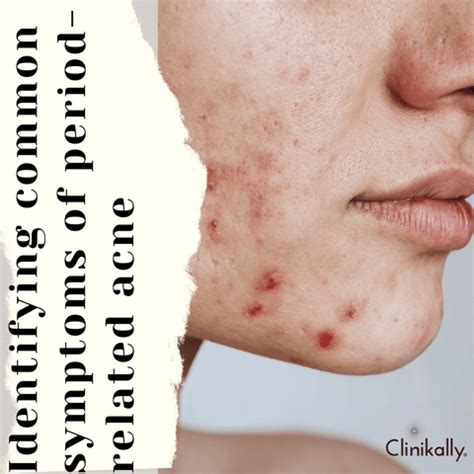 Period Acne: Symptoms, Causes and Treatment | Clinikally