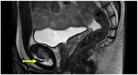 The Role of MRI in Groin Pain Syndrome in Athletes