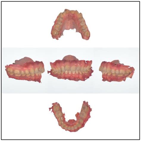 Digital Planning Technique for Surgical Guides for Prosthetic Implants ...