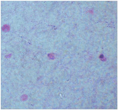 Cryptosporidium spp. Infection in Adult Kidney Transplant Patients: A ...