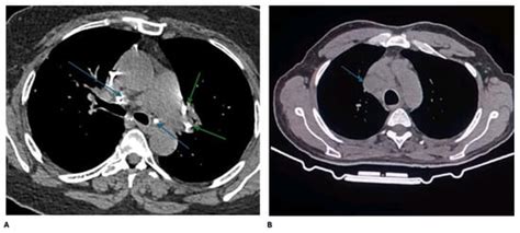 Unlocking the Diagnostic Challenge of Tuberculosis and Sarcoidosis ...
