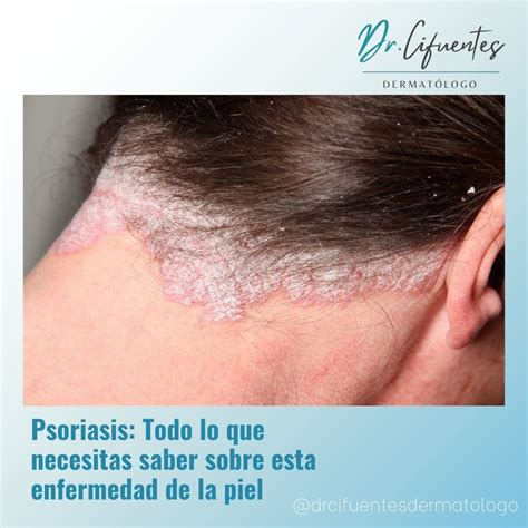 Psoriasis: Todo lo que necesitas saber sobre esta enfermedad de la piel ...