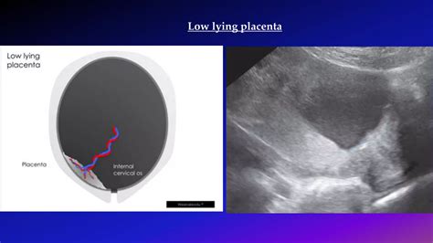 Ultrasound Imaging of Placenta | PPTX