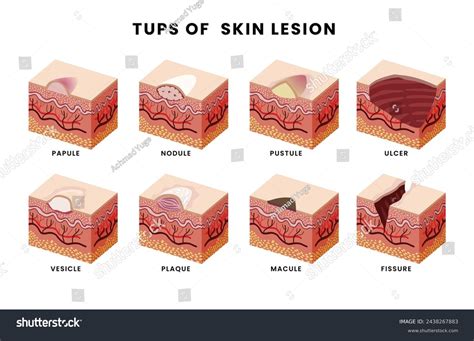 What Is A Lesion
