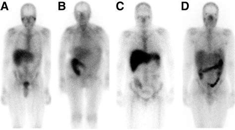 Image result for Radionuclide Scan
