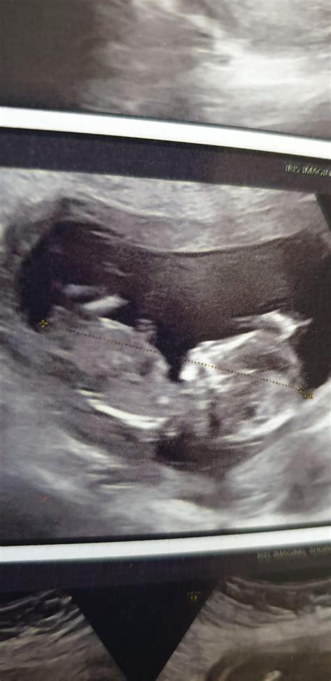 13 Week Ultrasound Pictures