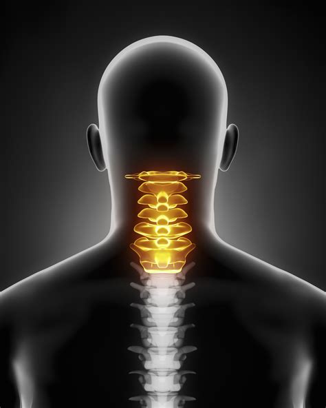 Anterior Cervical Fusion Surgery | Dr. Prpa - Spine Surgeon