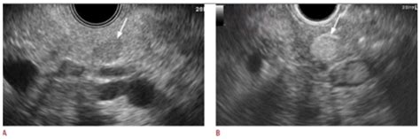 Basic Principles and Role of Endoscopic Ultrasound in Diagnosis and ...
