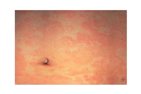 What Are The Rash On Stomach at Mary Smithey blog