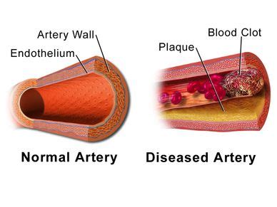 Ctvsuk - Peripheral Artery Disease, Pad