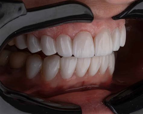 Root Canal Crown Front Tooth