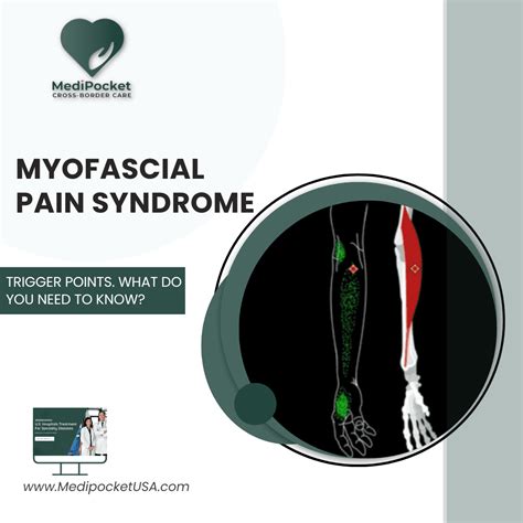 Chronic Myofascial Pain Syndrome Symptoms
