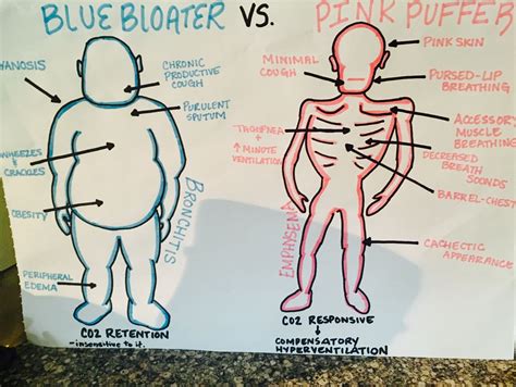 Copd Pink Puffer Blue Bloater | Education Suisse
