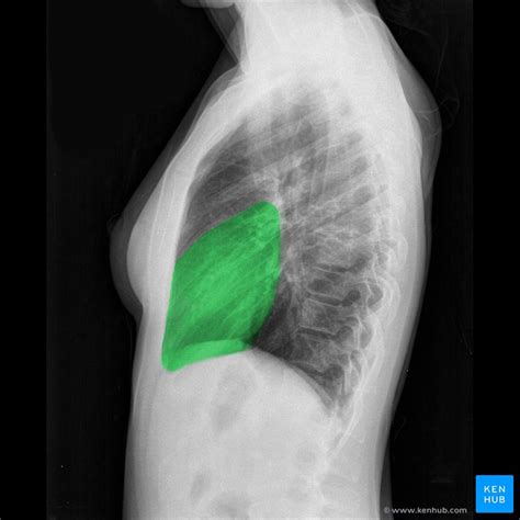 Image result for Chest X-Ray Tutorial
