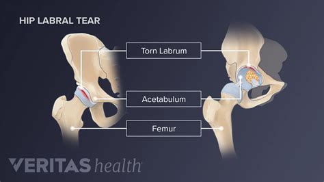 Can a Hip Labral Tear Cause Low Back Pain?