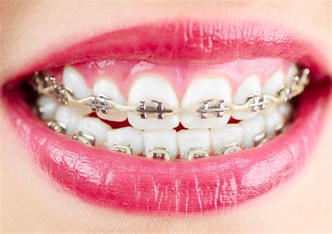 Orthodontic Braces Screw at Henry Omalley blog